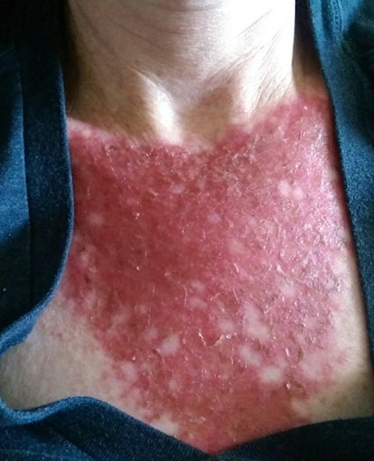 A person with burns and splotches on neck 