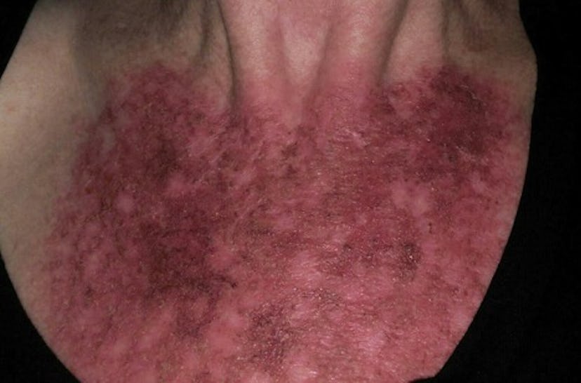 A person with severe burns on neck 