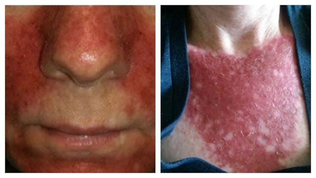 People who have severe burns on their faces and necks