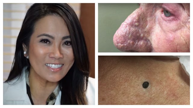 Dr. Pimple and extraction examples