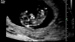 Ultrasound Of A Baby