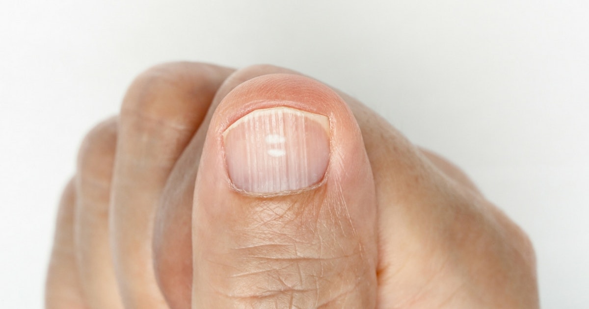 Got White Spots On Your Nails? This Is What It Is