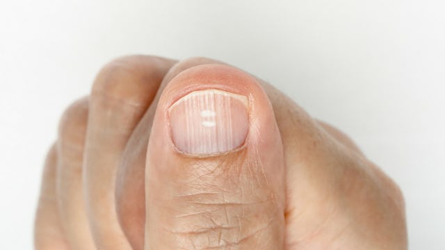 spots on nail