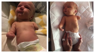 A two-part collage of baby Forrest who was born with limb anomalies