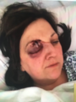 Dina Simpson after getting hit with a ball during a baseball game which left her blind in her right ...