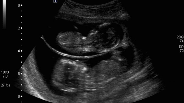 A photo of an ultrasound of twins in a mother's womb.