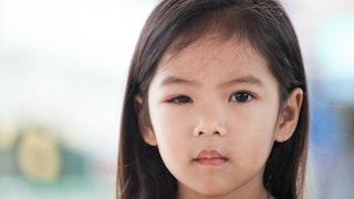 A portrait of a brunette girl suffering from pink eye