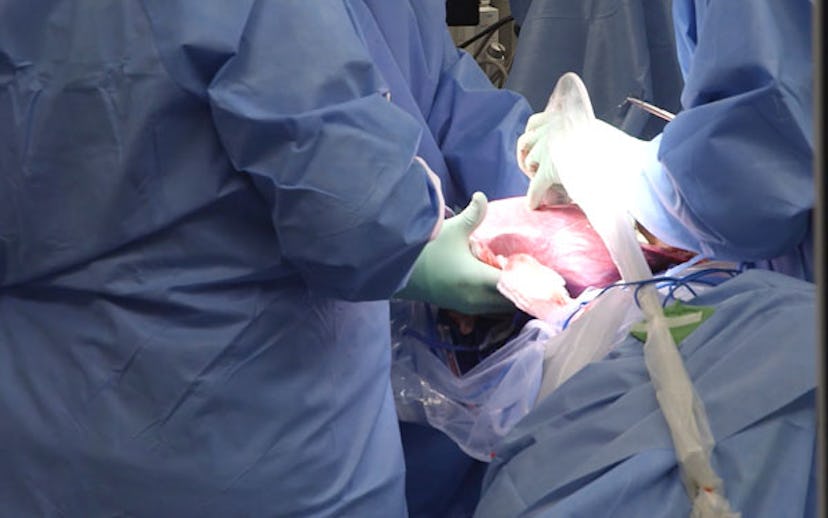 Doctors performing the fetal spina bifida surgery. 