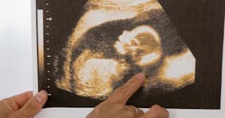 ramzi method, ramzi theory, baby ultrasound