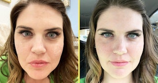 I Got Under-Eye Fillers And Here Are 5 Things To Know: Woman side by side before and after eye fille...