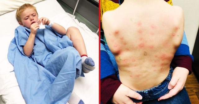 My Son Has Eosinophilic Esophagitis: bumps on small boys back