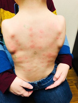 My Son Has Eosinophilic Esophagitis: bumps on small boys back