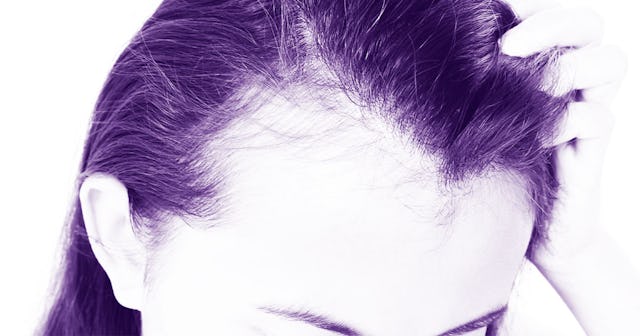 Close-Up Of Woman With Hair Loss Against White Background