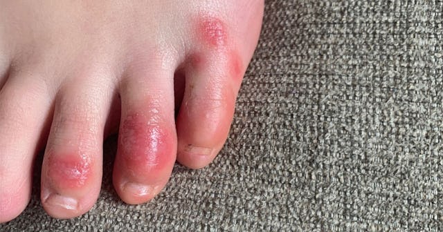 ‘COVID Toes’ Are A Possible Symptom For Us To Watch Out For