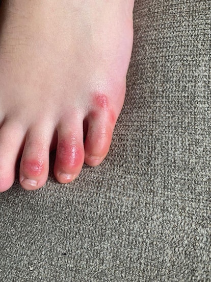 ‘COVID Toes’ Are A Possible Symptom For Us To Watch Out For