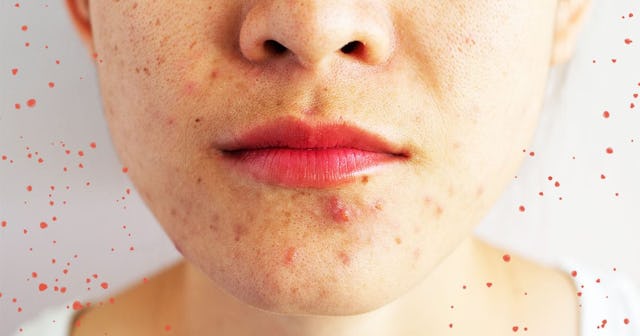 Closeup of woman half face with problems of acne inflammation
