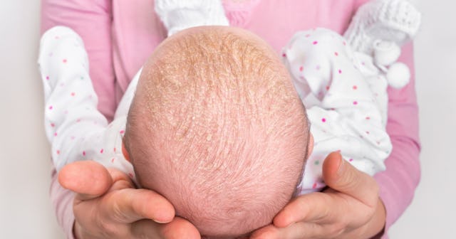 Baby Dry Scalp