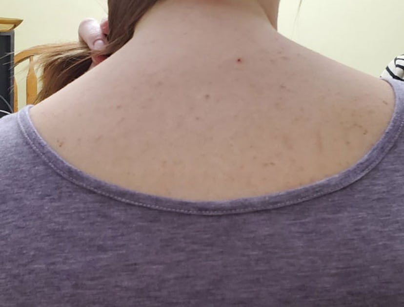 Jennifer Otto's upper back and neck who suffers from pruritic folliculitis