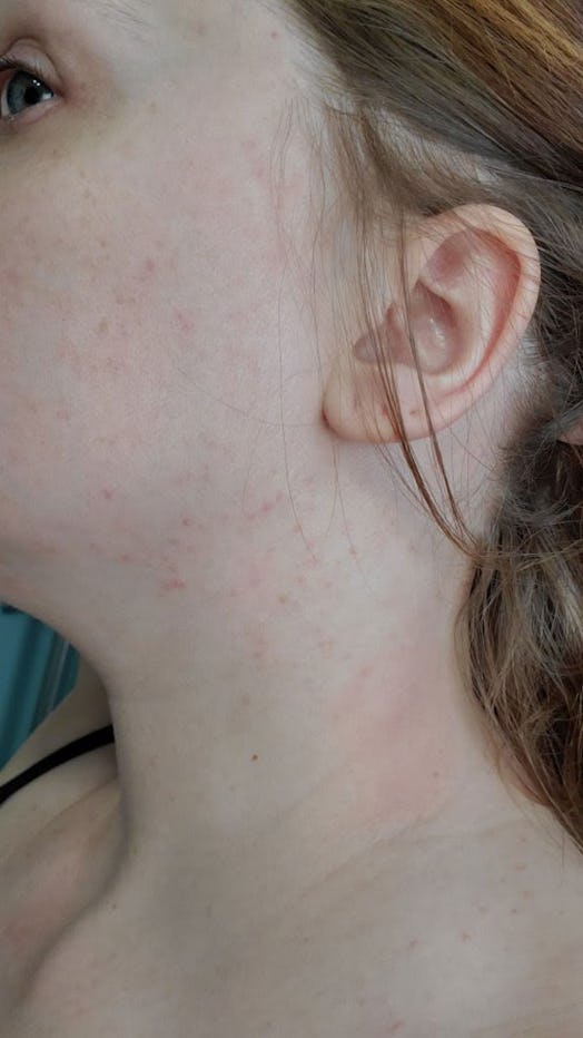 Jennifer Otto's left cheek and neck as she is experiencing pruritic folliculitis