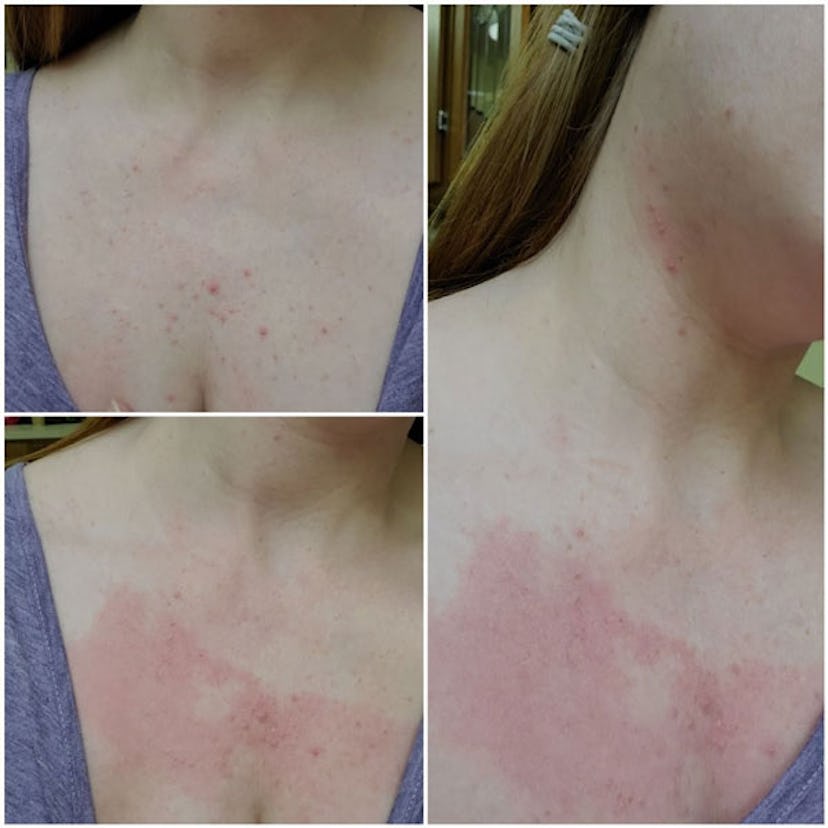 A three-part collage of a Jennifer Otto's neck with visible pruritic folliculitis