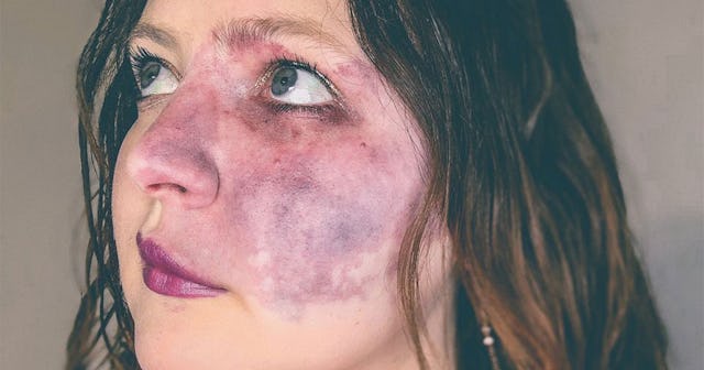 A woman with a port wine stain birthmark on the left side of her face 