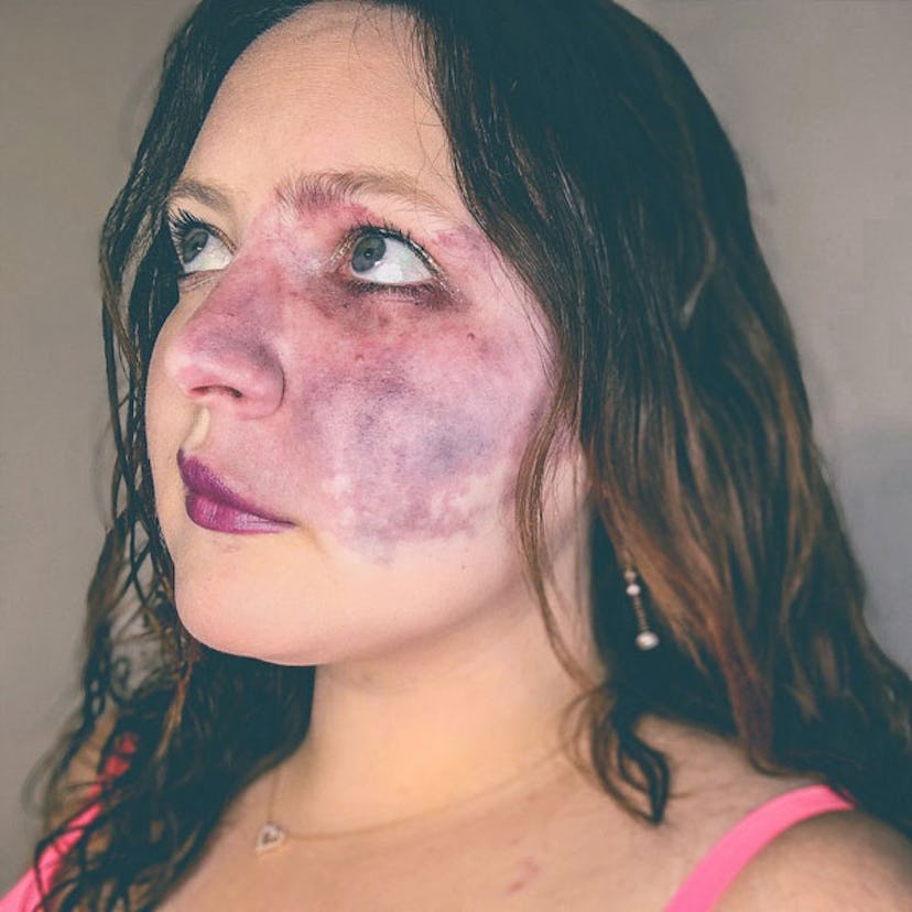 A woman with a port wine stain birthmark on the left side of her face 