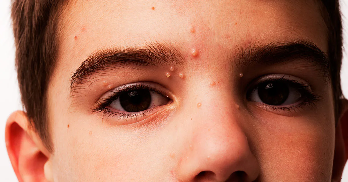 Molluscum Is The Childhood Rash We All Dread — But It’s Going To Be OK ...