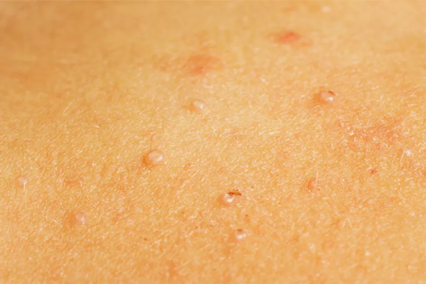 Molluscum Is The Childhood Rash We All Dread — But It’s Going To Be OK ...