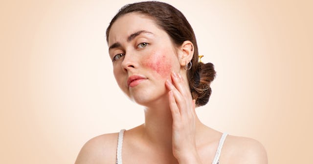 Acne Rosacea