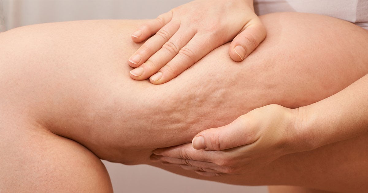 What Causes Cellulite?