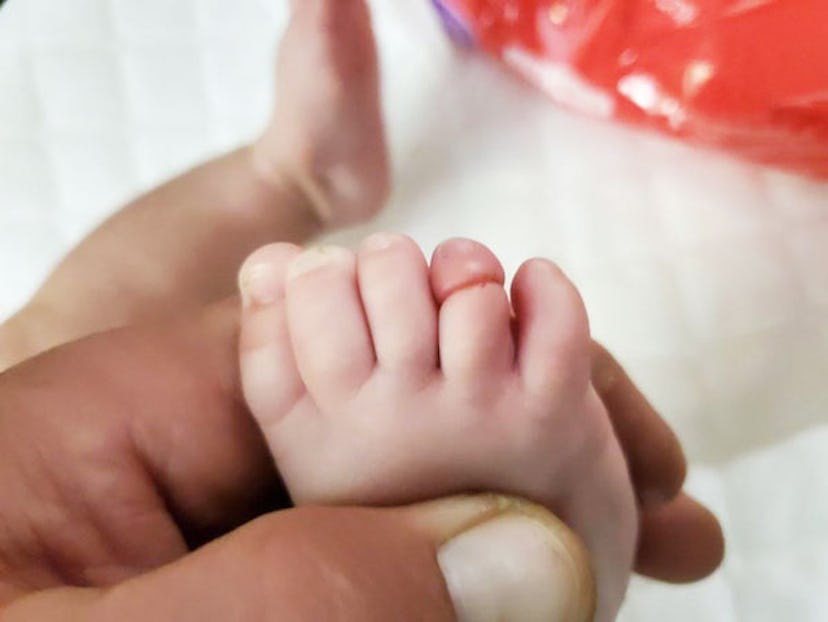 A closeup of a parent's hand holding a baby's foot which had a swollen toe because a hair strand got...