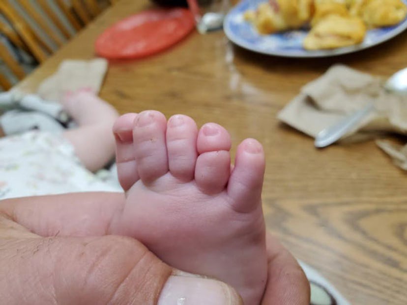 A closeup of a parent's hand holding a baby's foot, which had a swollen toe because a hair strand go...