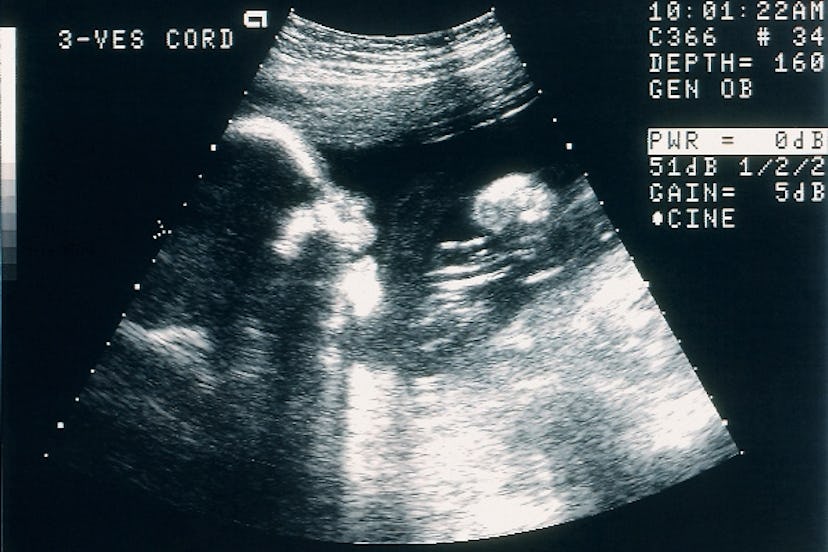 A sonogram is the image resulting from an ultrasound.