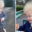 uncombable hair syndrome