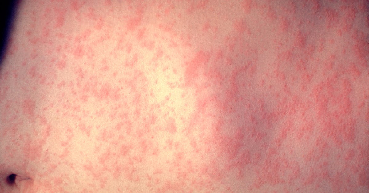 What Does A Measles Rash Look Like? Here's What Parents Should Look Out For