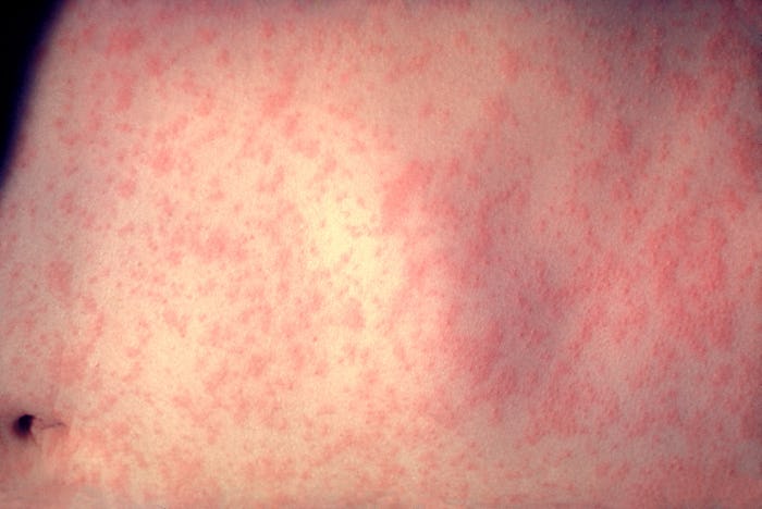 Measles rash covering the skin