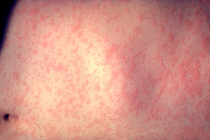 Measles rash covering the skin