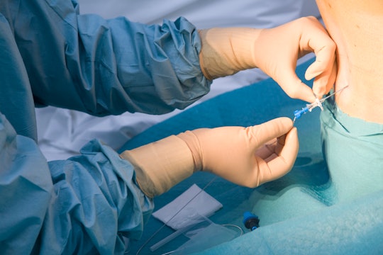 a woman in labor receiving an epidural