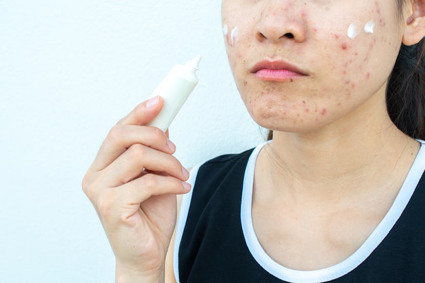 Suddenly developing sever acne might be a sign of infertility. 