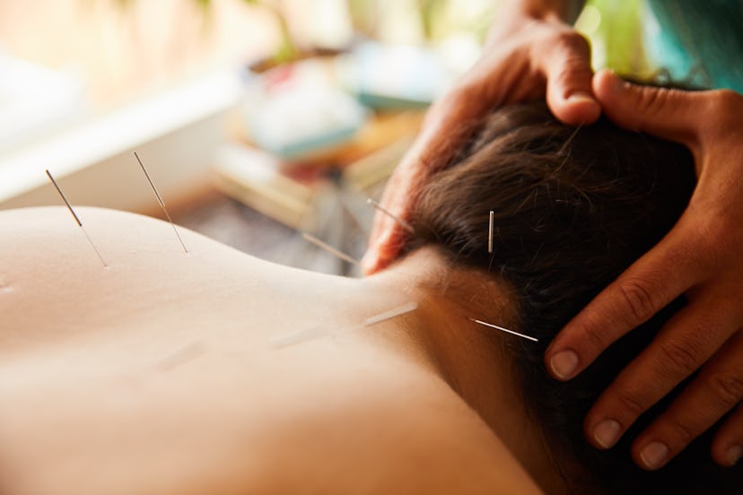 A woman has acupuncture treatment. In combination with other therapies, like CBT or antidepressants,...