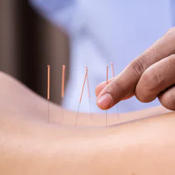 A woman has acupuncture needles placed on her skin. Acupuncture may help with certain symptoms of de...