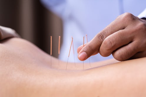 A woman has acupuncture needles placed on her skin. Acupuncture may help with certain symptoms of de...