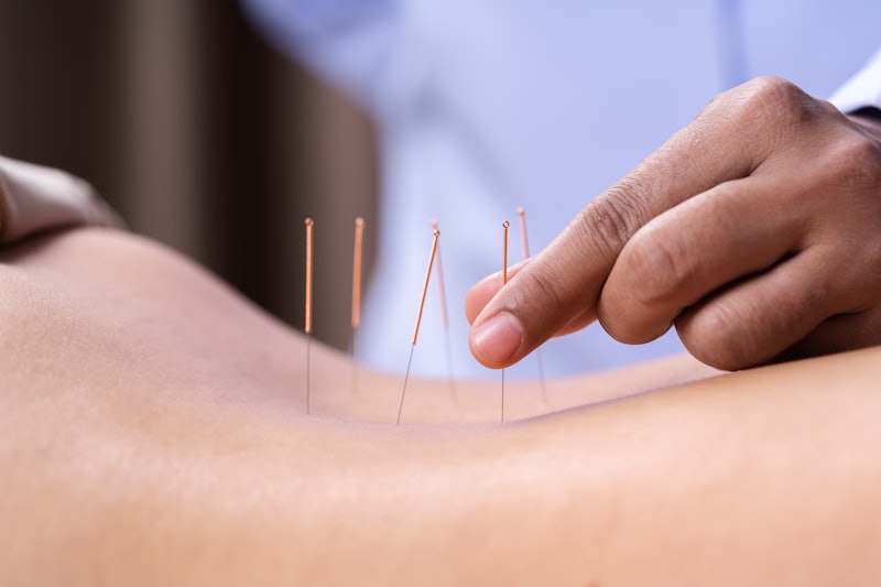 A woman has acupuncture needles placed on her skin. Acupuncture may help with certain symptoms of de...