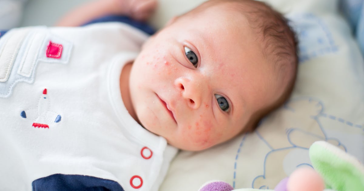 Is Baby Eczema An Allergic Reaction Here S What Experts Want You To Know Is Baby Eczema An Allergic Reaction Here S What Experts Want You To Know