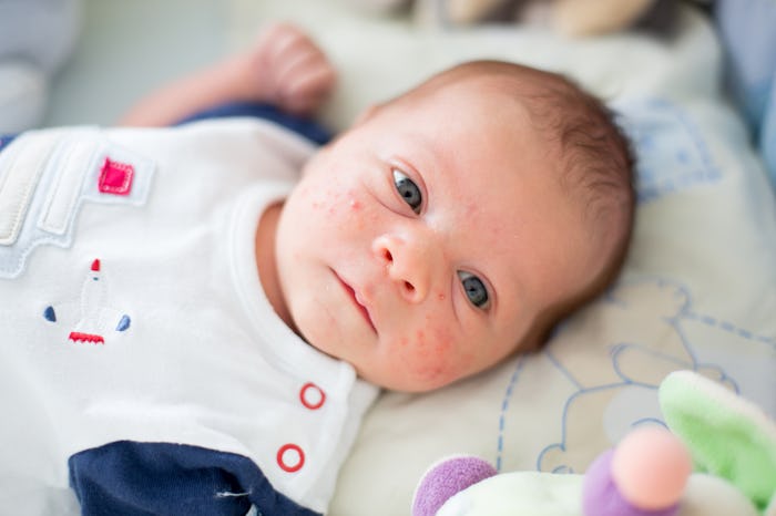 Parents may question whether or not their child's baby eczema is an allergic reaction, but experts s...