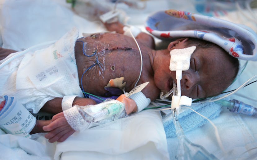 premature infant in hospital