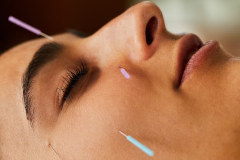 A woman with acupuncture needles in her face. Virtual acupuncture is now a thing that you can do fro...