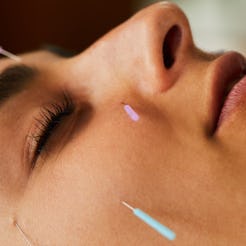 A woman with acupuncture needles in her face. Virtual acupuncture is now a thing that you can do fro...