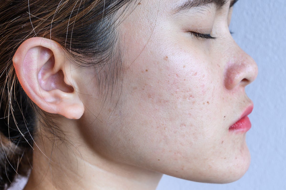 How To Treat Fungal Acne On Your Face When Nothing Else Works