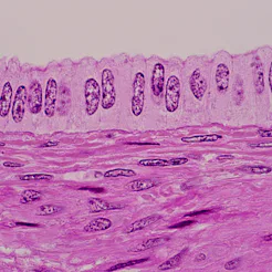 Uterine cells under a slide microscope. Doctors bust these myths about cervical cancer & hpv.